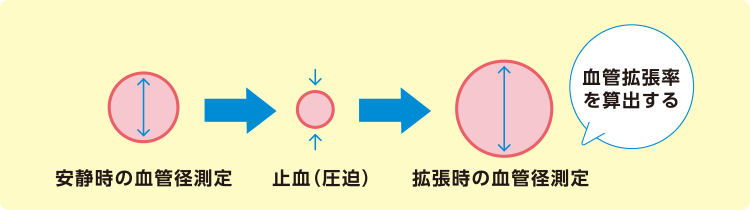 FMD（血流依存性血管拡張反応）の図